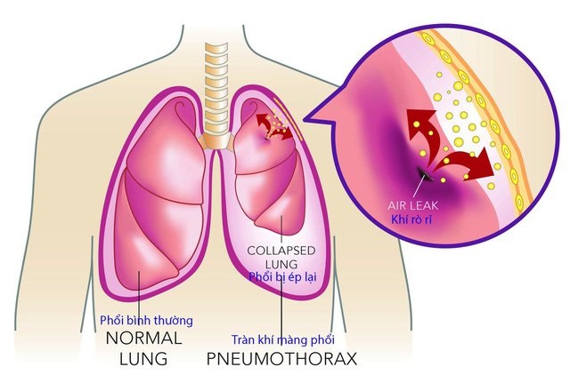 Điển hình nhất là các triệu chứng liên quan tới hệ hô hấp, đặc biệt là tràn dịch màng phổi.